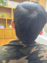 体验后-大麦微针植发全国连锁