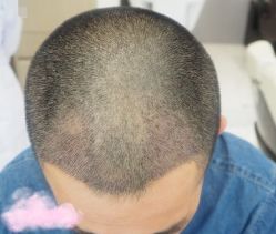 -大麦微针植发丨全国连锁