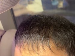 -碧莲盛·不剃发植发