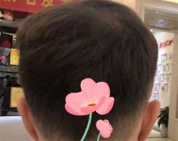 点击看大图 -大麦微针植发全国连锁