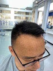 体验后-大麦微针植发全国连锁