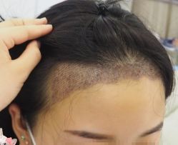 -大麦微针植发丨全国连锁
