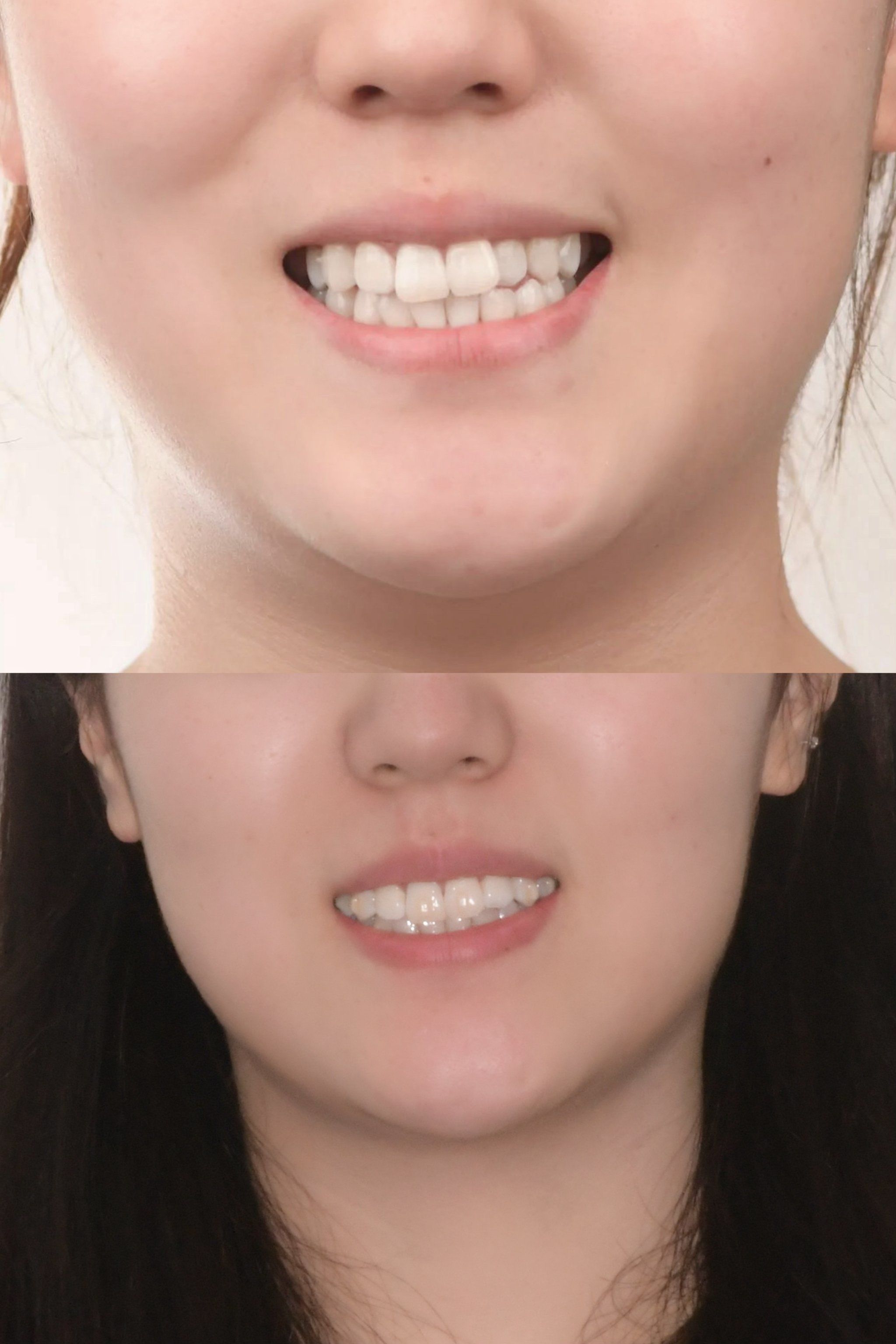 他指着我的扫出来的模型和拍的片子,有条不紊地分析我的牙齿,咬合