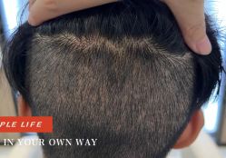 -大麦微针植发全国连锁