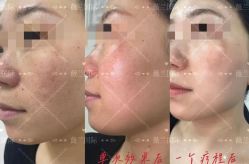 -薇兰专业脱毛连锁机构