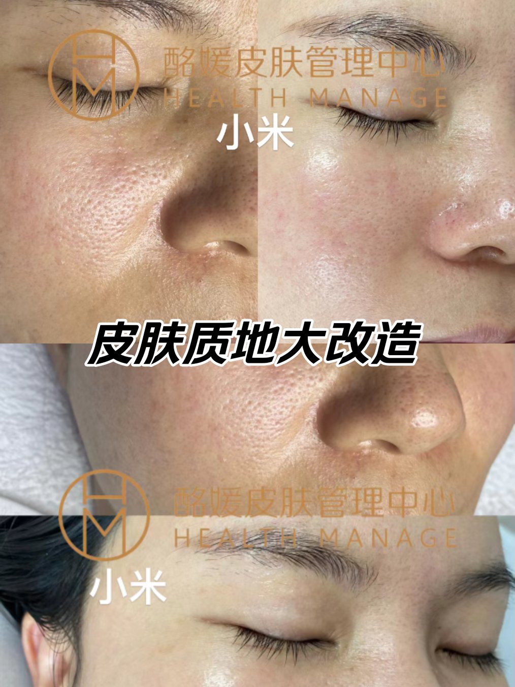 微针射频做一次有效果吗