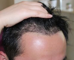 -大麦微针植发丨全国连锁