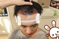 -大麦微针植发丨全国连锁