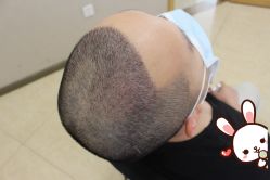 -大麦微针植发丨全国连锁