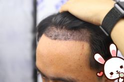 -大麦微针植发丨全国连锁