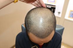 -大麦微针植发丨全国连锁