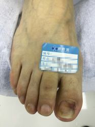 点击看大图 -派恩宜灰指甲鸡眼嵌甲手足癣