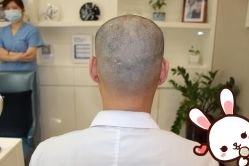 -大麦微针植发丨全国连锁