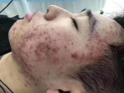 -苗方清颜痘肌研究所