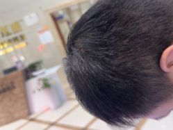 -碧莲盛·不剃发植发