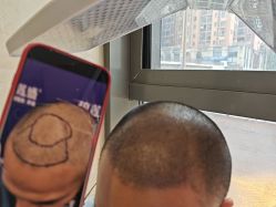 -碧莲盛·不剃发植发