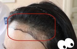 -大麦微针植发全国连锁