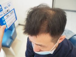 -大麦微针植发丨全国连锁