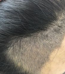 -大麦微针植发全国连锁