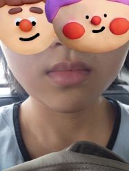 体验前-深圳春天阳光医院·轮廓抗衰中心