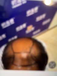 -碧莲盛·不剃发植发