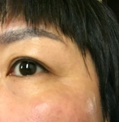 点击看大图 做完提斑五天-北京英煌医疗美容