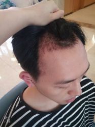 -大麦微针植发丨全国连锁