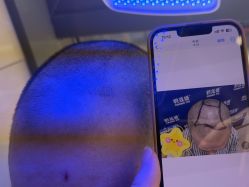 -碧莲盛·不剃发植发