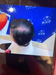 -碧莲盛·不剃发植发
