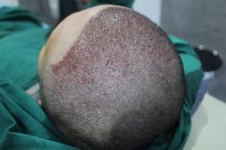 点击看大图 -大麦微针植发丨全国连锁