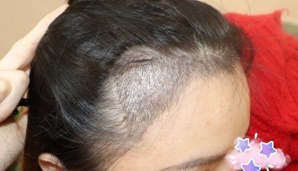 -大麦微针植发丨全国连锁