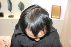 -大麦微针植发丨全国连锁