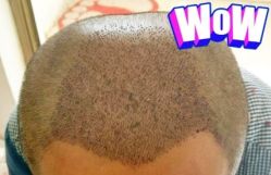 -大麦微针植发丨全国连锁