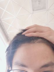 -大麦微针植发丨全国连锁