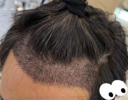 -大麦微针植发全国连锁