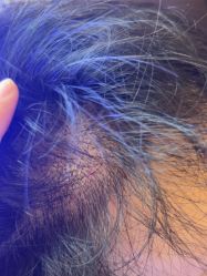 -碧莲盛·不剃发植发