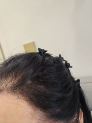 -碧莲盛·不剃发植发