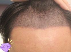 -大麦微针植发丨全国连锁