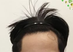 -大麦微针植发全国连锁