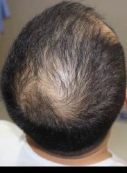 点击看大图 -大麦微针植发全国连锁