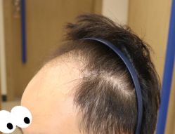 -大麦微针植发全国连锁