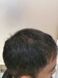 -碧莲盛·不剃发植发