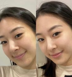 体验前-石家庄苏亚美联臣医疗美容医院