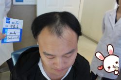 -大麦微针植发丨全国连锁