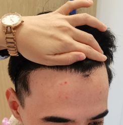 -大麦微针植发丨全国连锁