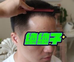 -大麦微针植发丨全国连锁