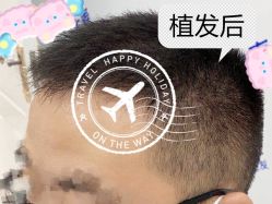 -大麦微针植发全国连锁