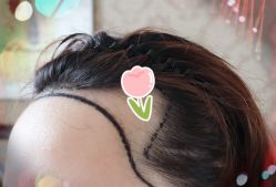 -大麦微针植发全国连锁