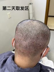 -大麦微针植发全国连锁