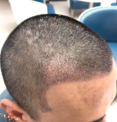 -大麦微针植发丨全国连锁